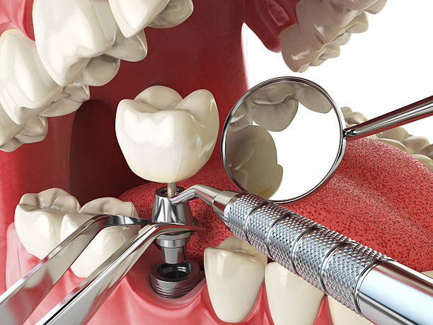 Best Chipped Tooth Repair Near Me  in St James, MO
